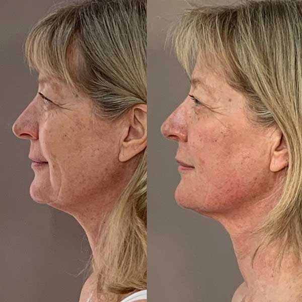 Collagen lift before / after