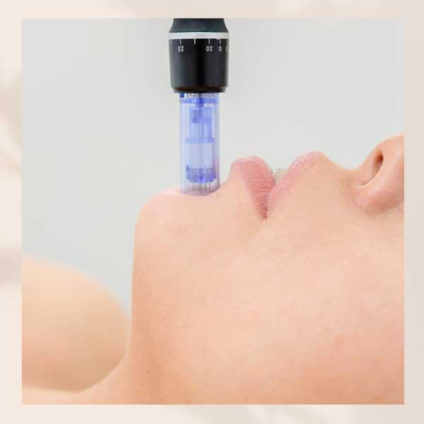 Microneedling