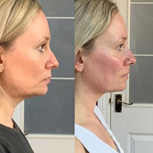 Collagen lift before / after