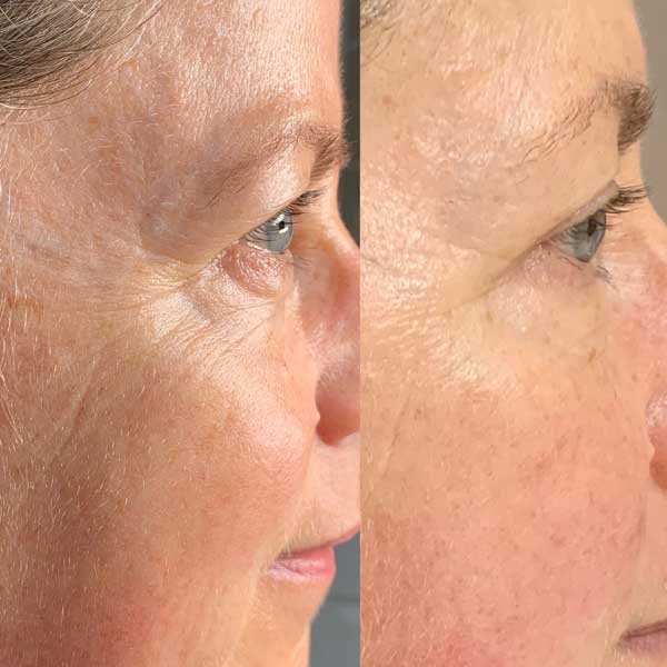 Collagen lift before / after