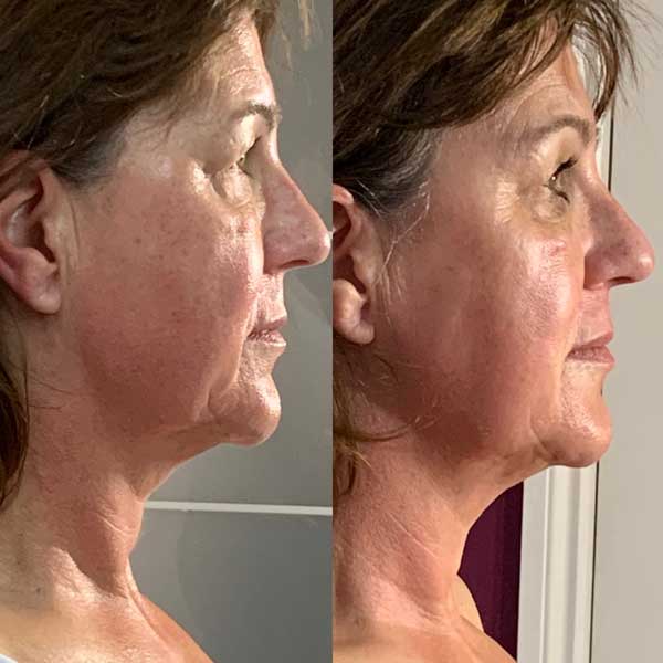 Collagen lift before / after