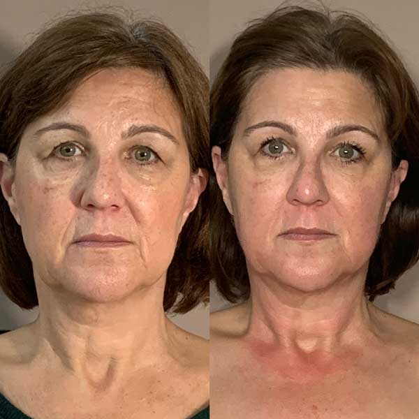 Collagen lift before / after