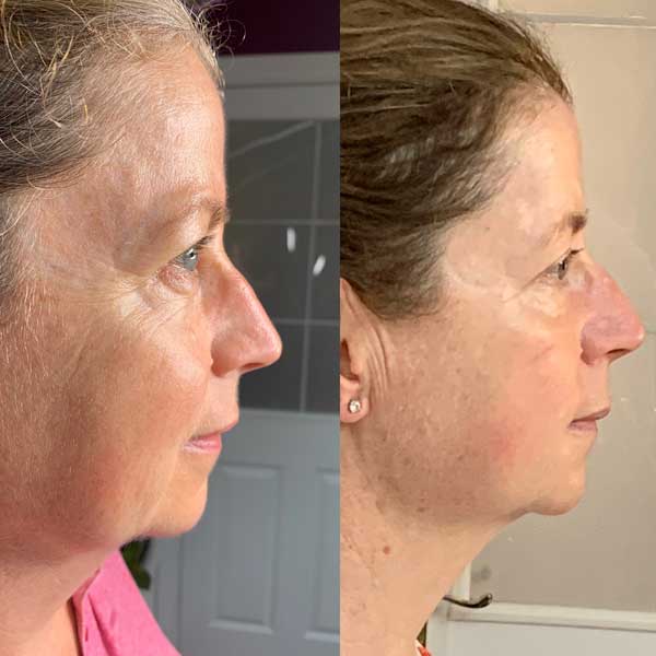 Collagen lift before / after