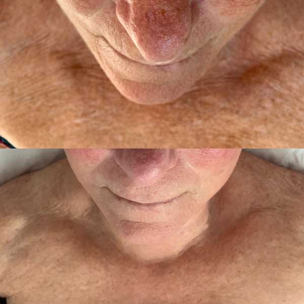 Collagen lift before / after