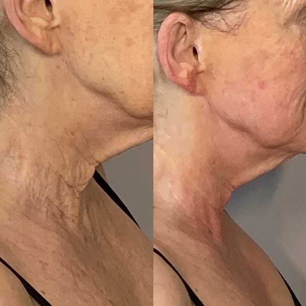 Collagen lift before / after