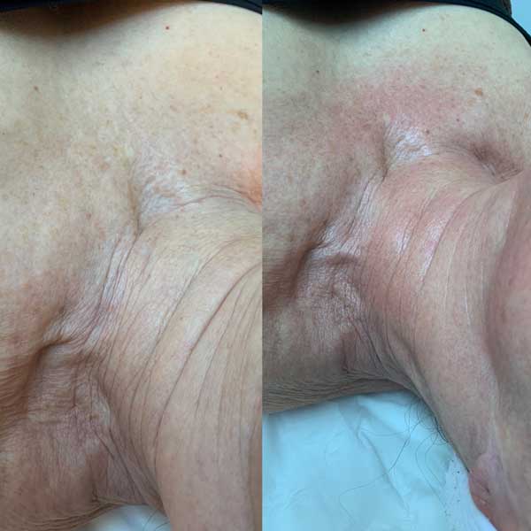 Collagen lift before / after