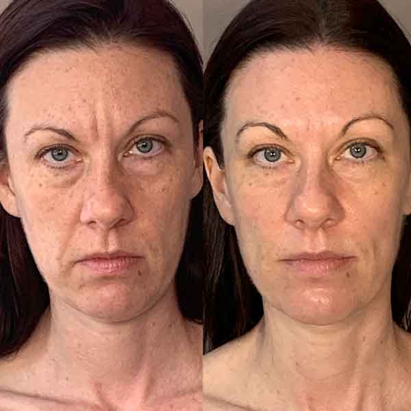 Collagen lift before / after