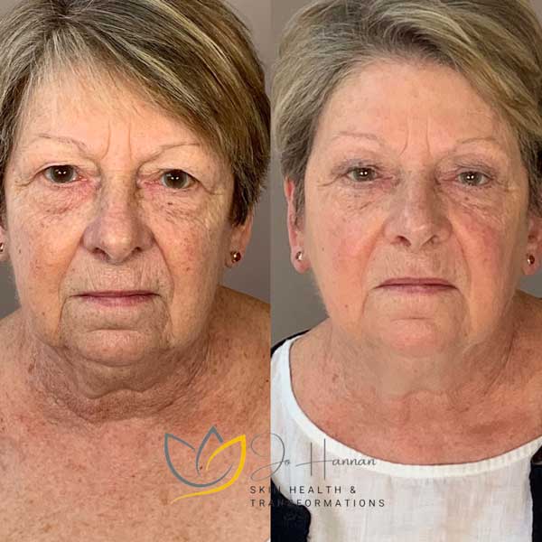 Collagen lift before / after