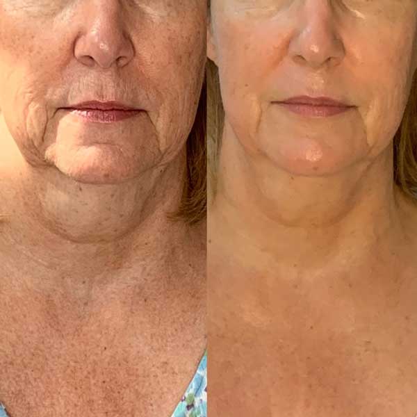 Collagen lift before/after