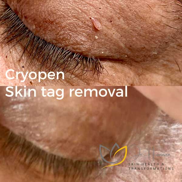 Cryopen skin tag removal