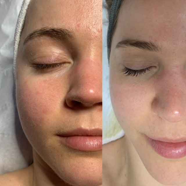 dermaviduals skin treatment before/after