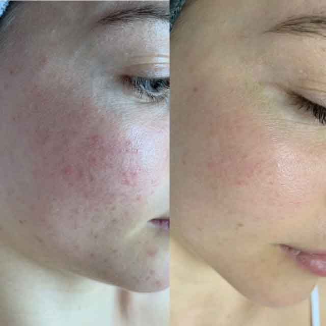 dermaviduals skin treatment before/after