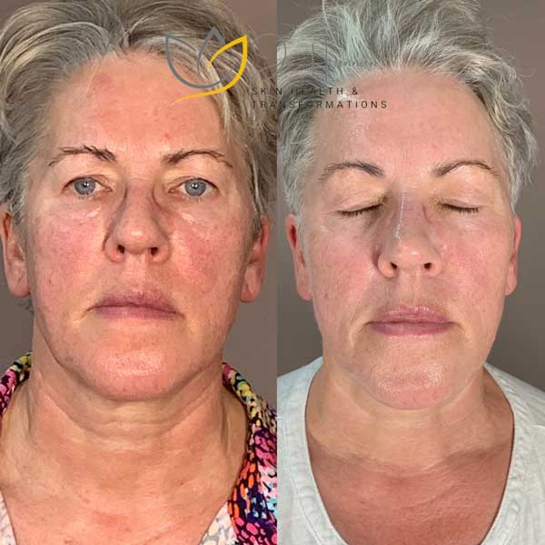 Skin transformation before/after