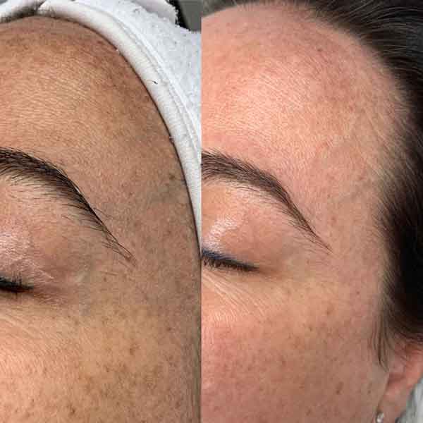 Skin transformation before/after