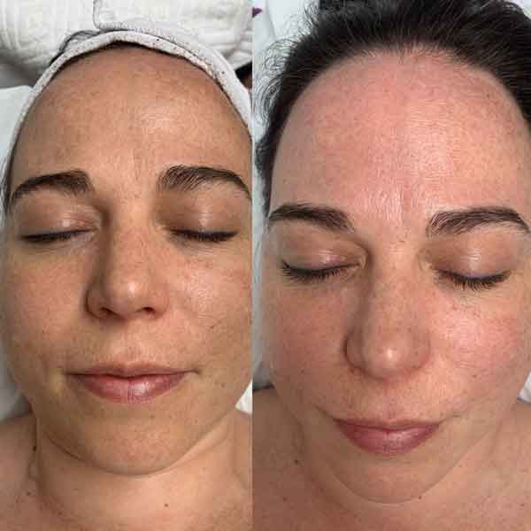 Skin transformation before/after