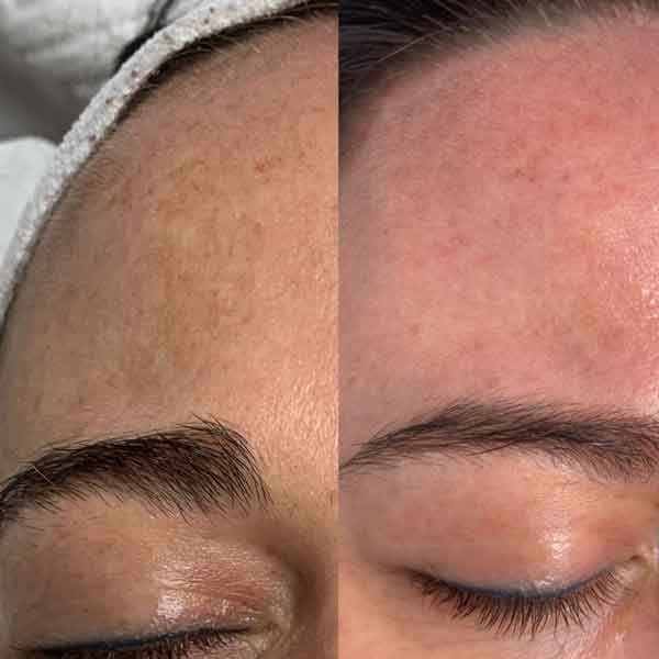 Skin transformation before/after
