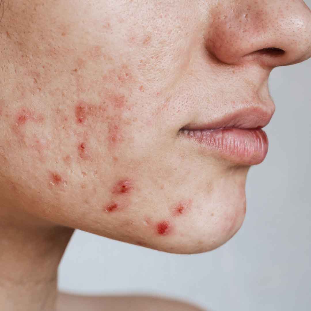 Acne