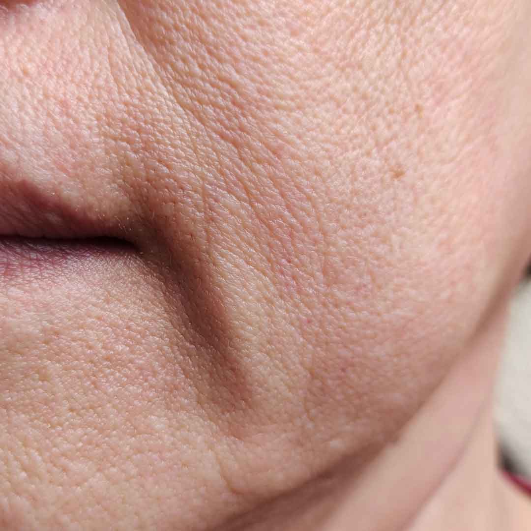 Photo aged skin