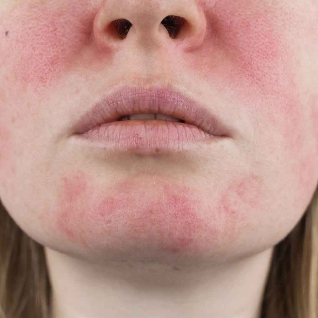 Rosacea