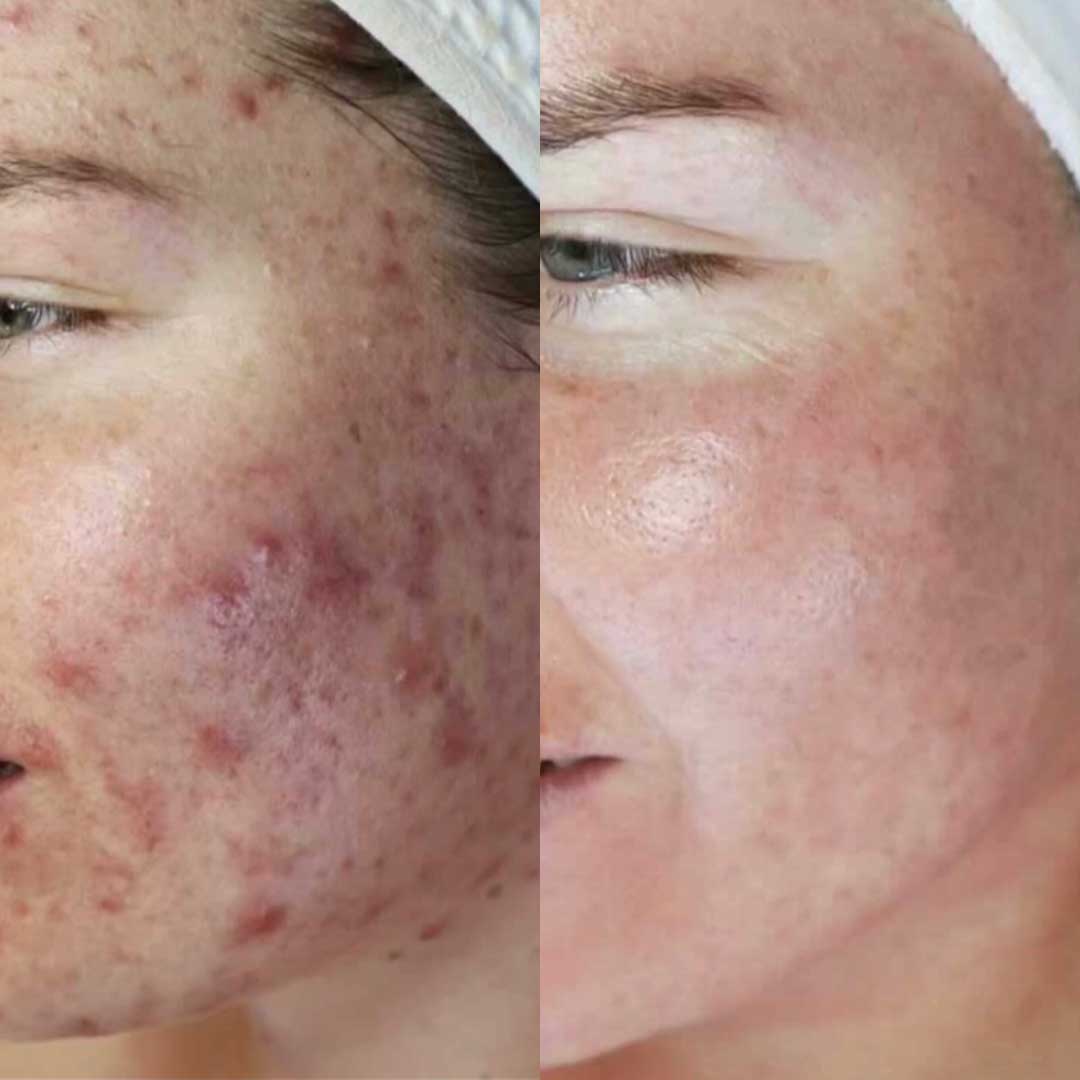 Dermalux acne treatment before and after