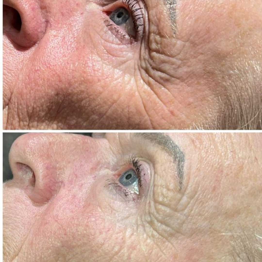 Dermalux skin rejuvination before and after
