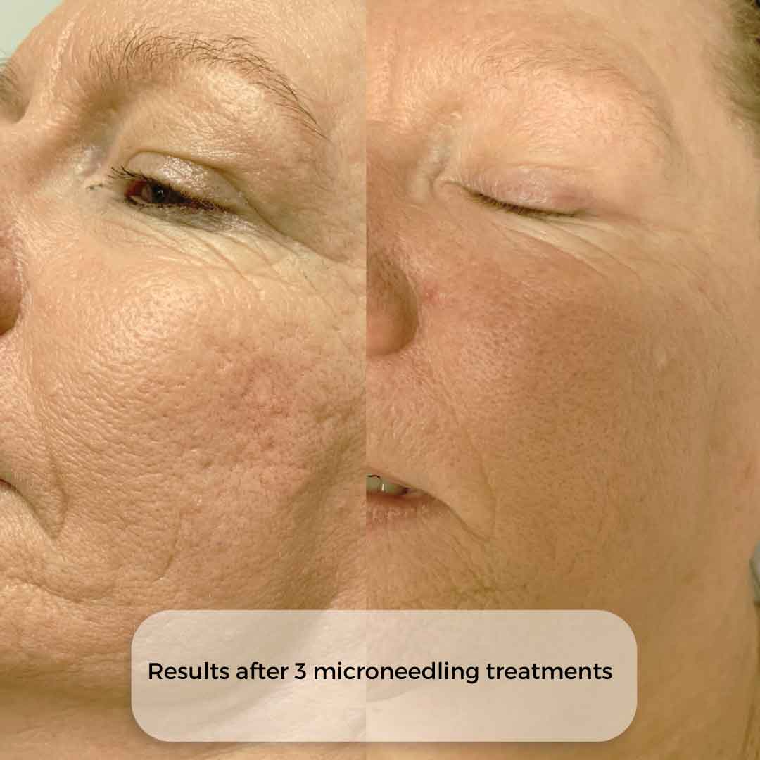 Before and after microneedling