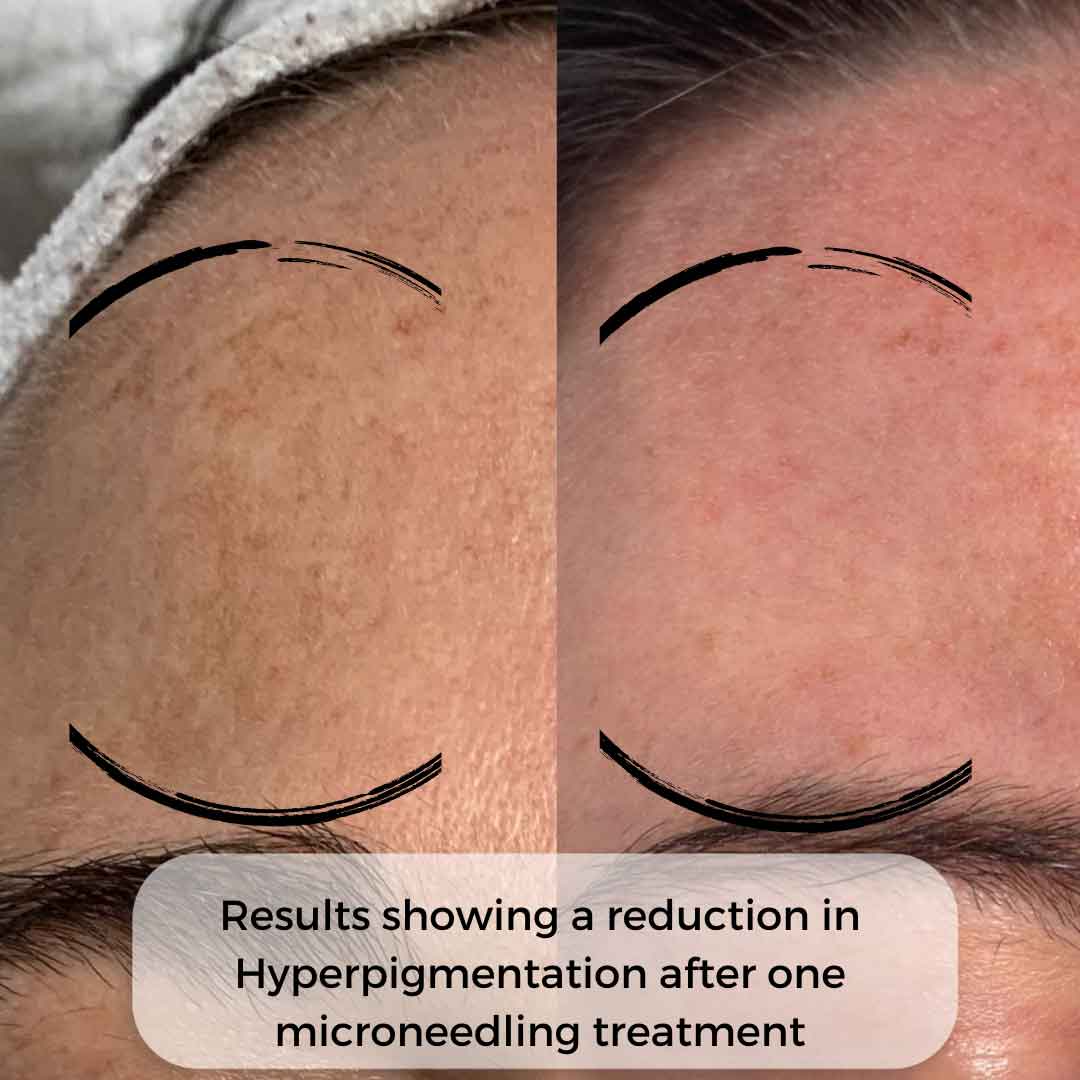 Before and after microneedling