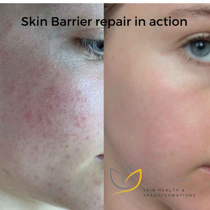 Skin barrier repair in action