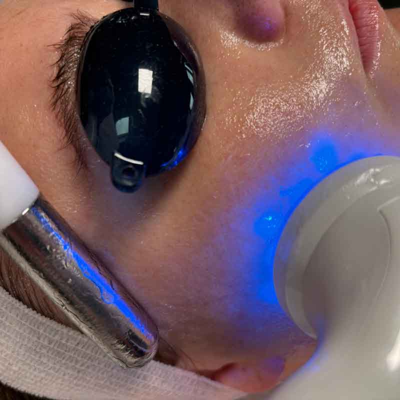 Neurotris PicoWave Treatment