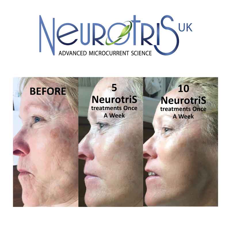 Neurotris PicoWave Treatment Results